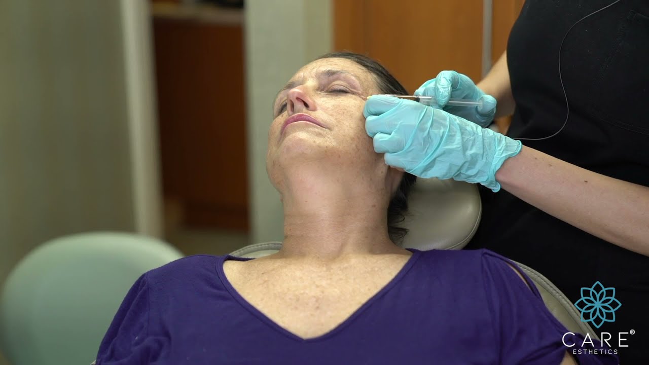 PRF Injections into Crows Feet by CARE Esthetics